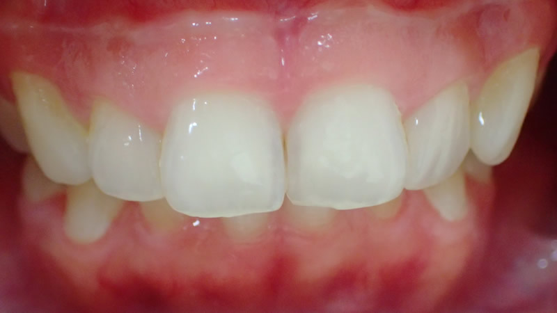 ラミネート治療により歯の小さいガミースマイルを改善した症例・治療前