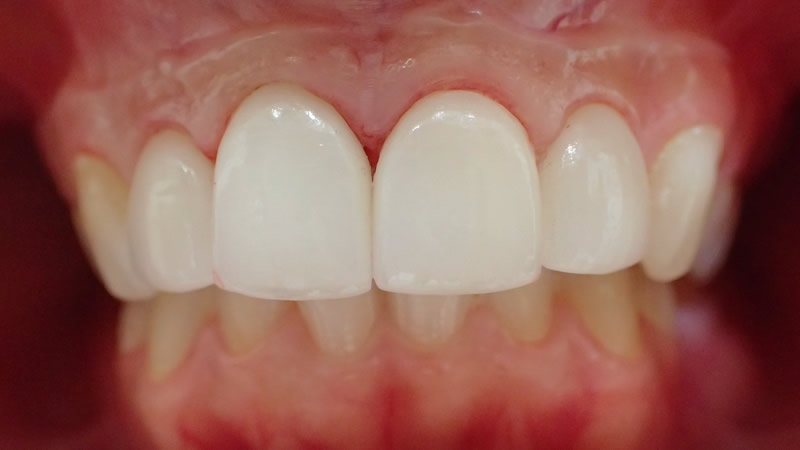 ラミネート治療により歯の小さいガミースマイルを改善した症例・治療後