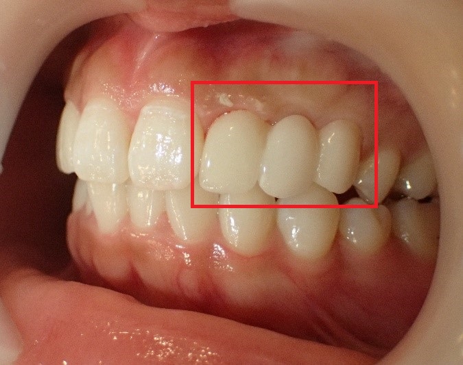 奥歯のブリッジ治療後