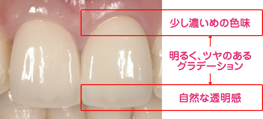 レイヤリングによるセラミック治療
