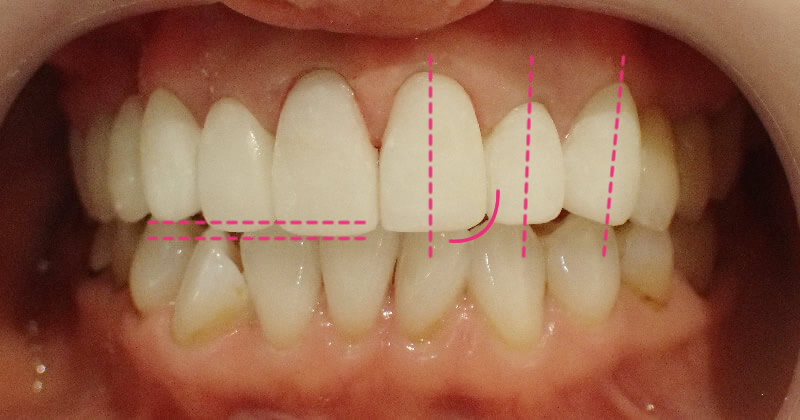 セラミック治療における仮歯の調整