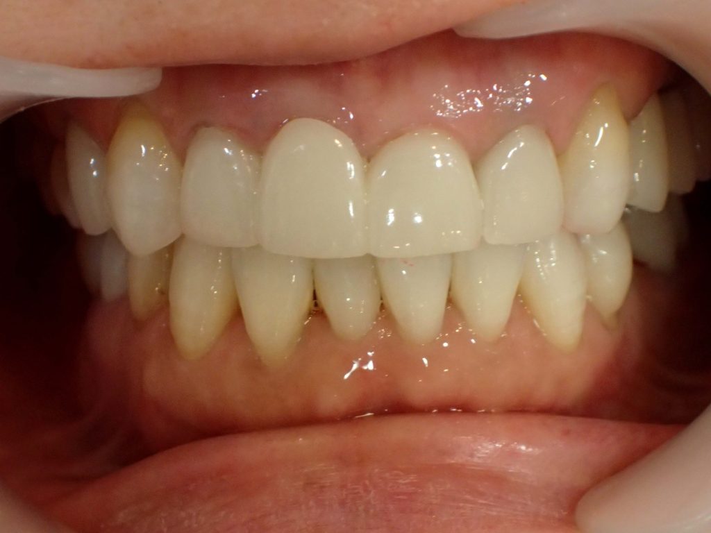 セラミックによる古い差し歯の再治療後