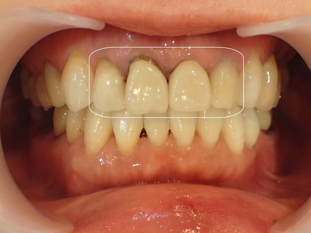 セラミックによる古い差し歯の再治療前